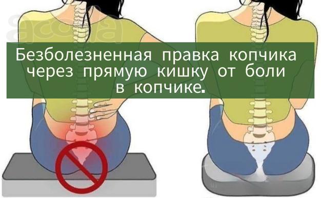 Лечение копчика (кокцигодиния, травма, перелом, вывых)